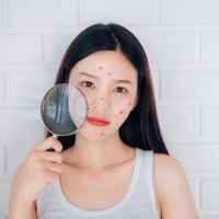 Diet untuk Hilangkan Jerawat Viral di TikTok, Ini Pendapat Dermatologist