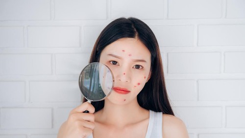 Ilustrasi wanita dengan jerawat