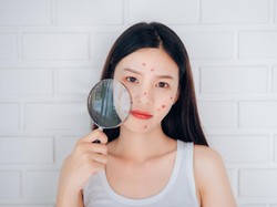 Jerawat Susah Hilang? Bisa Jadi Masalahnya Ada di Skin Barrier