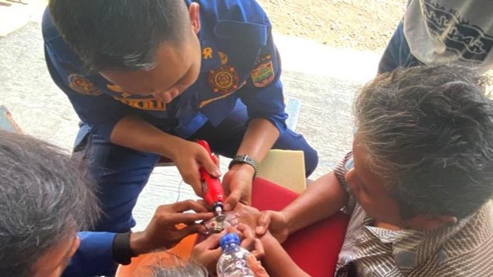 Proses pelepasan cincin terjebak di jari.