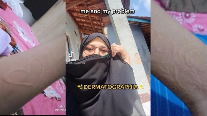 Viral kulit wanita di Sukabumi bisa digambar secara alami.