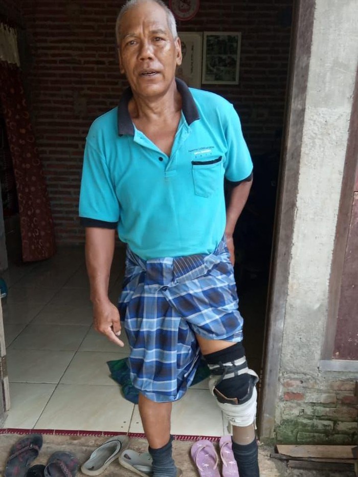 Sarlan kehilangan kaki kirinya karena tertimpa mesin hammer dan harus diamputasi. Semenjak saat itu, ia menggunakan kaki palsu dan bekerja seperti biasanya.
