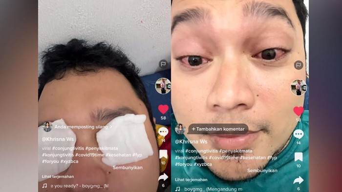 Viral sakit mata Viral sakit mata dikira covid