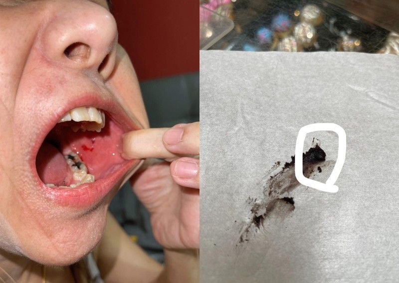 Ngeri! Mulut Wanita Ini Berdarah karena Gigit Potongan Kaca dalam Donat