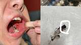Ngeri! Mulut Wanita Ini Berdarah karena Gigit Potongan Kaca dalam Donat