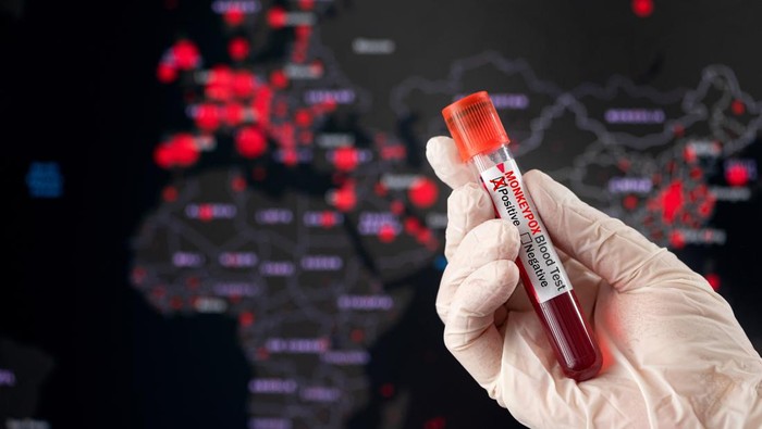 Monkeypox  positive blood tube and world pandemic map