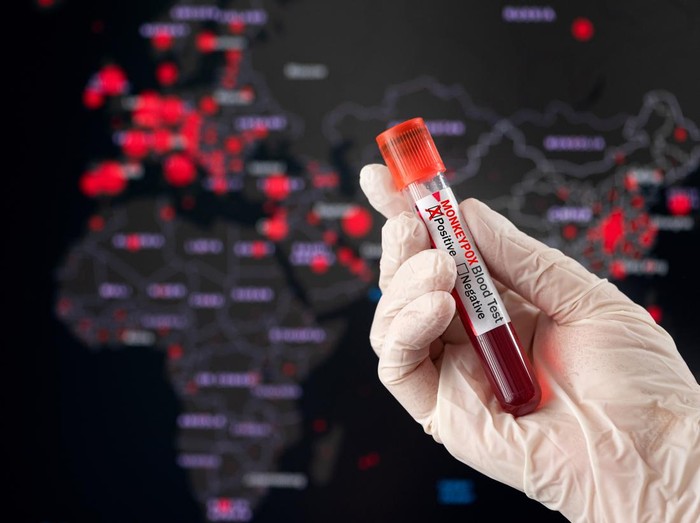 Monkeypox  positive blood tube and world pandemic map