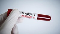 Ngeri! Penampakan Hidung Pria yang Membusuk Gegara Idap Cacar Monyet dan HIV
