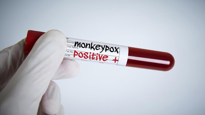 cacar monyet Doctor holding Monkeypox Test Tube Result Positive. Global virus concept.