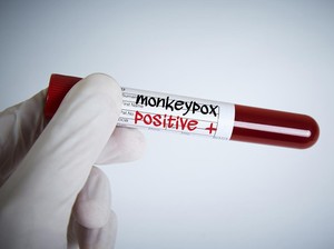 Beda Tipis Gejala Cacar Monyet Vs Sakit Kulit Biasa, Menurut Satgas IDI