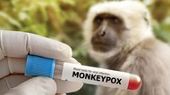 Apakah Cacar Monyet Berbahaya untuk Anak Sekolah?