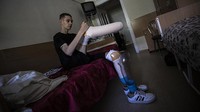 Pasca terkena bom, ia menjalani perawatan di pusat rehabilitasi di Kyiv.  