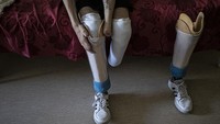 Daniyel kehilangan sebagian kaki, pergelangan tangan kiri, dan 4 jari di tangan kanannya dalam perang Rusia-Ukraina.  