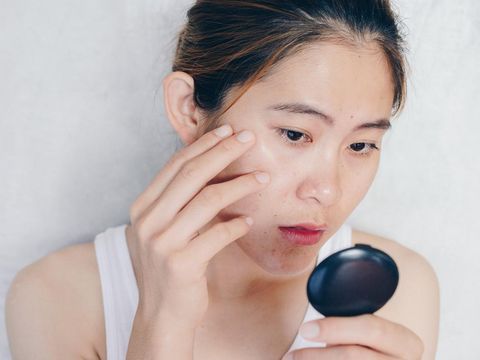 Conceptual shot of Acne & Problem Skin on female face.