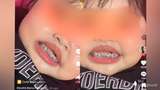 Awas! Viral Balita Dipakaikan Behel, Ini Sederet Bahayanya Kata Dokter Gigi Anak
