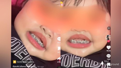 Viral TikTok seorang ibu nekat memasang behel pada bayi di bawah lima tahun.
