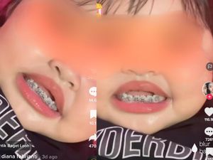 Awas! Viral Balita Dipakaikan Behel, Ini Sederet Bahayanya Kata Dokter Gigi Anak