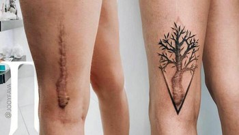 Bekas luka jahitan. Diotak-atik jadi tato pohon..