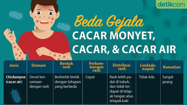 Kenali Perbedaan Gejala Cacar Cacar Air Dan Cacar Monyet