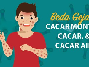 Beda Gejala Cacar, Cacar Air, dan Cacar Monyet