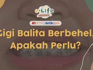 Usia Berapa Sih Anak Boleh Pasang Behel?