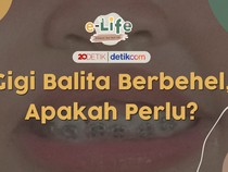 Usia Berapa Sih Anak Boleh Pasang Behel?