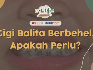 Usia Berapa Sih Anak Boleh Pasang Behel?