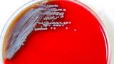 Bakteri Mematikan Ditemukan di AS, Sudah Ada Dua Kasus Penyakit