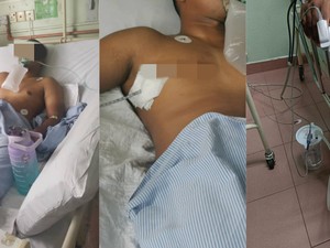 Paru-paru Pria Ini Bocor Gegara Rokok dan Vape, Ini Keluhan Awalnya