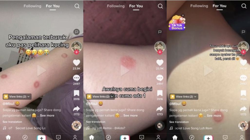 Viral wanita mengalami ruam seluruh tubuh. (Ist DetikHealth)