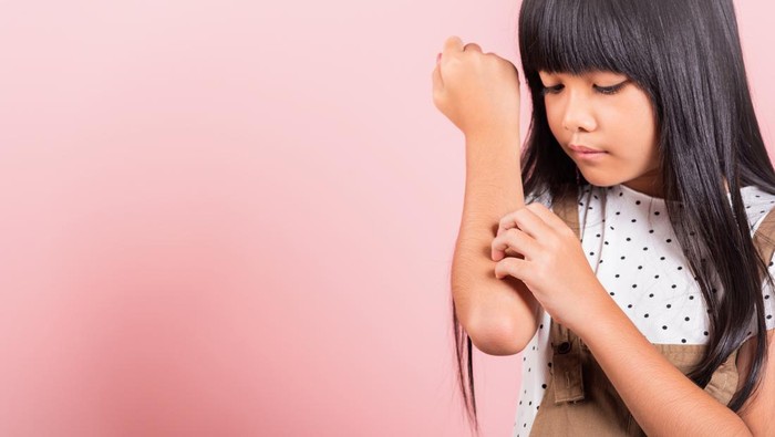 Ilustrasi scabies pada anak atau gatal