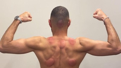 Rahasia Fisik Prima Karim Benzema: Bekam dan Tinju!