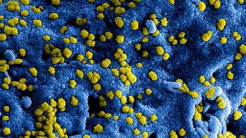 Selanjutnya, masih dengan Virus Corona. Kali ini didominasi partikel bulat kecil berwarna kuning di permukaan sel Vero yang ditandai dengan warna biru.