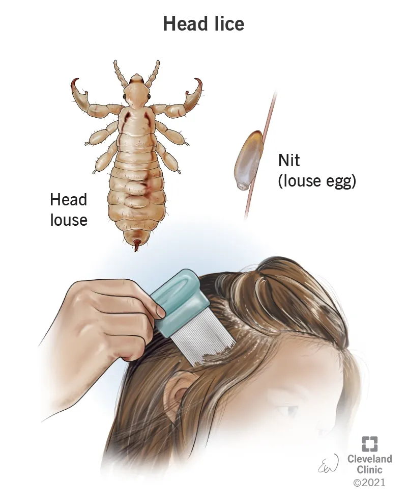 Ilustrasi siklus hidup kutu rambut. Foto: Cleveland Clinic