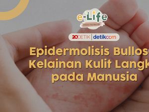Penyakit Kulit Langka, Hanya ada 66 Pasien di Indonesia