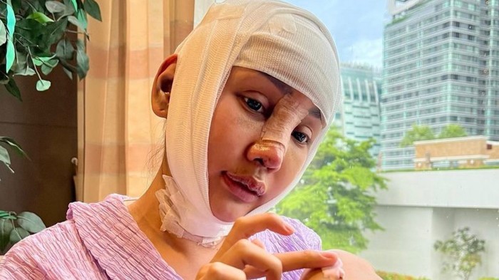Perjalanan operasi plastik Lucinta Luna