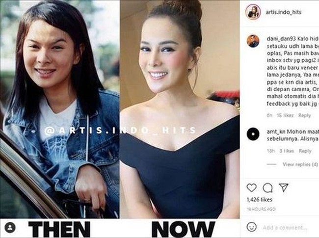 Perbedaan wajah Astrid dulu dan kini juga sempat menjadi viral di media sosial. Ia dituding telah melakukan oplas. Namun menurut penjelasannya saat menjadi bintang tamu di acara FYP (For Your Pagi) Trans 7 yang dipandu oleh Raffi Ahmad dan Irfan Hakim, Astrid dengan tegas menampik hal tersebut. Ia mengaku hanya melakukan tarik benang untuk bagian hidungnya. Foto: Instagram/@artis.indo_hits