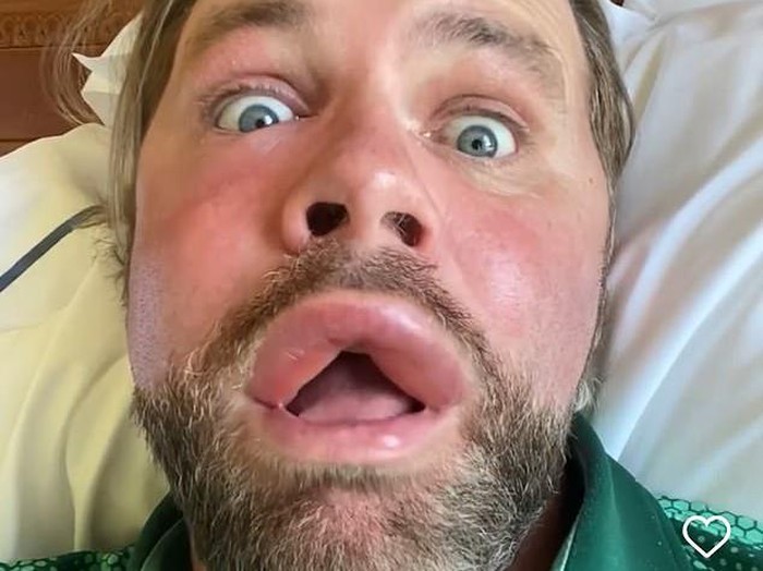 Brian McFadden Disengat Lebah Brian McFadden Disengat Lebah