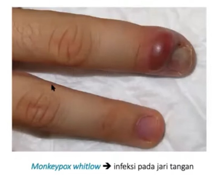 GEJALA CACAR MONYET Tangkapan Layar Youtube FKUI