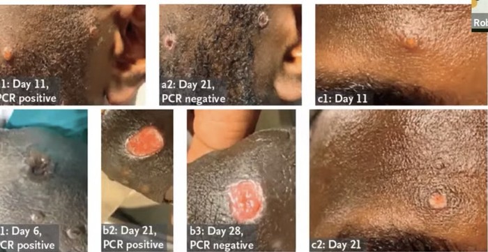 monkeypox monkeypox