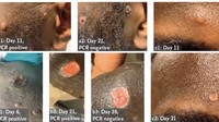Kasus pertama cacar monyet atau monkeypox sudah ditemukan di Indonesia. Penyakit ini memiliki ruam khas yang berbeda dengan cacar air. (Foto: British Medical Journal)