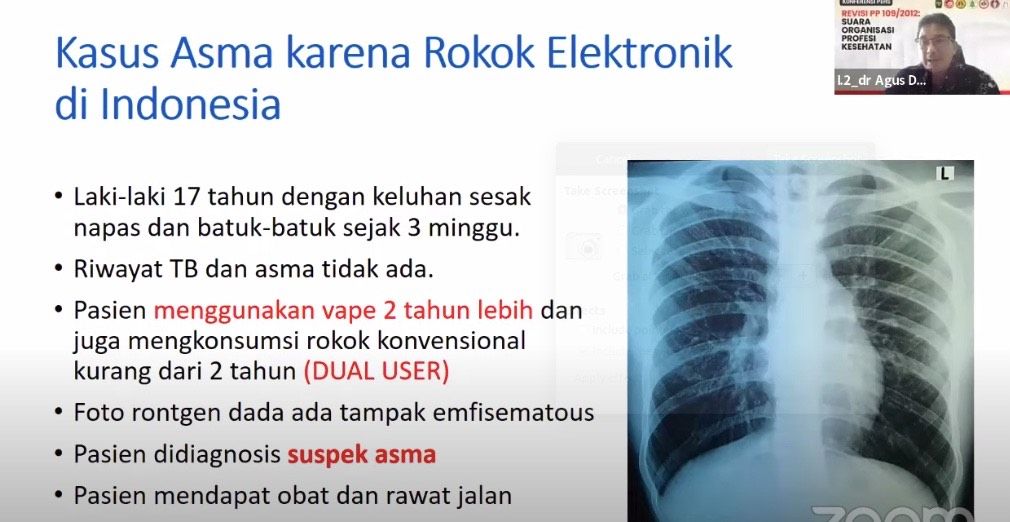 Pasien mengidap asma Pasien mengidap asma di Indonesia karena vape dan rokok