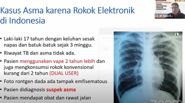Pasien mengidap asma Pasien mengidap asma di Indonesia karena vape dan rokok