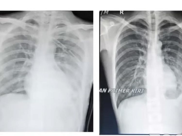 Lihat Lagi Potret Paru-paru Bocor Gegara Ngevape-Ngerokok, Yakin Nggak Tobat?