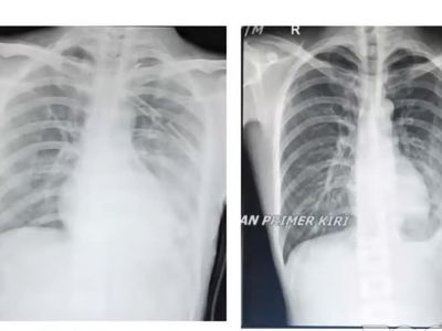 Lihat Lagi Potret Paru-paru Bocor Gegara Ngevape-Ngerokok, Yakin Nggak Tobat?