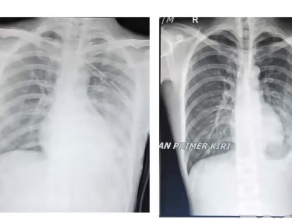 Yakin Mau Lanjut Ngevape? Ini Potret Pasien Terkapar di RS Gegara Paru Bocor
