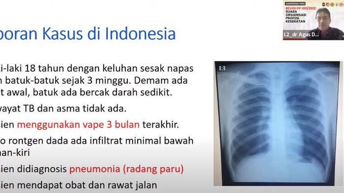 Radang paru Pasien yang terkena radang paru