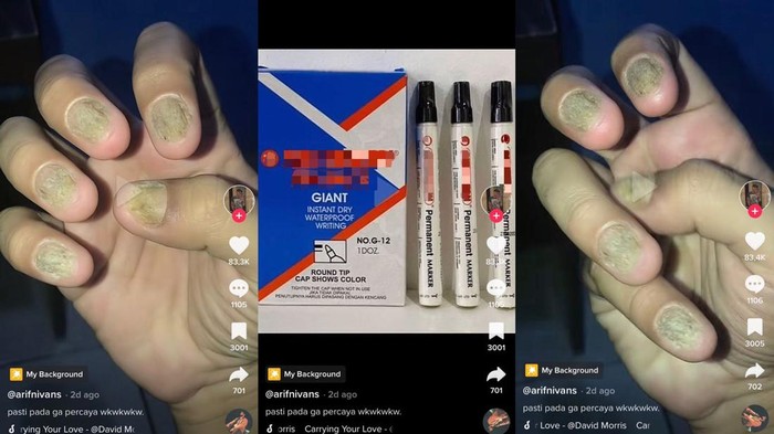 Viral TikTok kuku rusak karena spidol Viral di TikTok kuku pasien rusak karena spidol