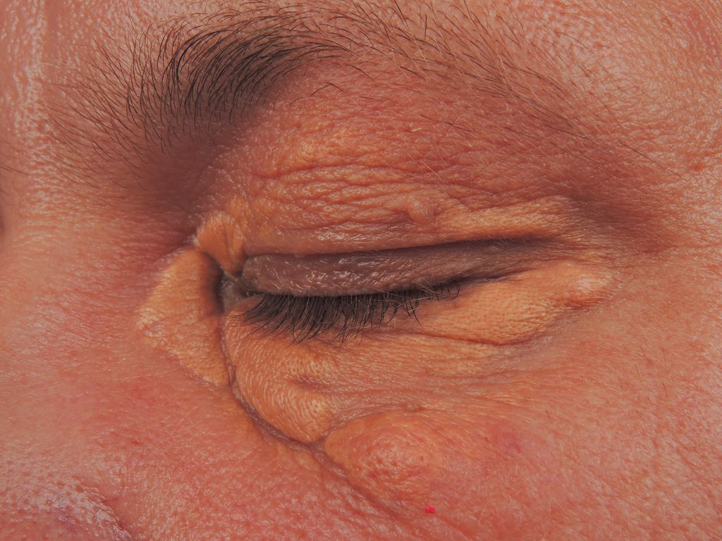 Xanthelasma patch (Photo by: BSIP/Universal Images Group via Getty Images)