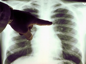 Hari Radiologi Sedunia dan Sejarah Wilhelm Conrad Rontgen
